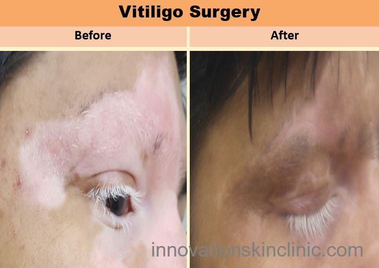 Vitiligo Surgery 2